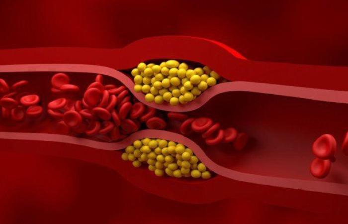 أظافرك قد تكشف عن ارتفاع الكوليسترول بالدم.. علامات تحذيرية لا تتجاهلها